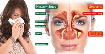 Cara Mengobati Sinusitis